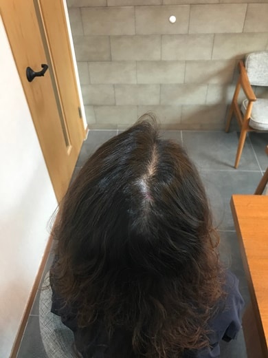 뉴헤어 두피문신 올려봅니다 !!!~!!!