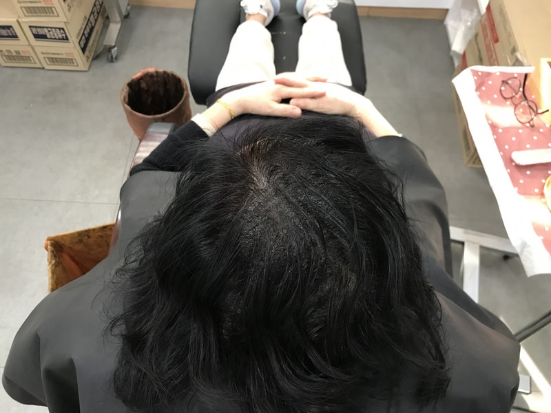 두피문신/색소요법