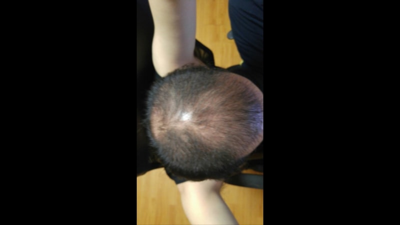 두피문신 리터치까지 끝냈습니다...