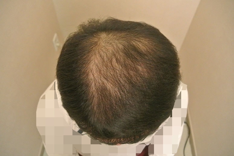 두피문신(흑채문신) 후기-연세모벨르 피부과의원