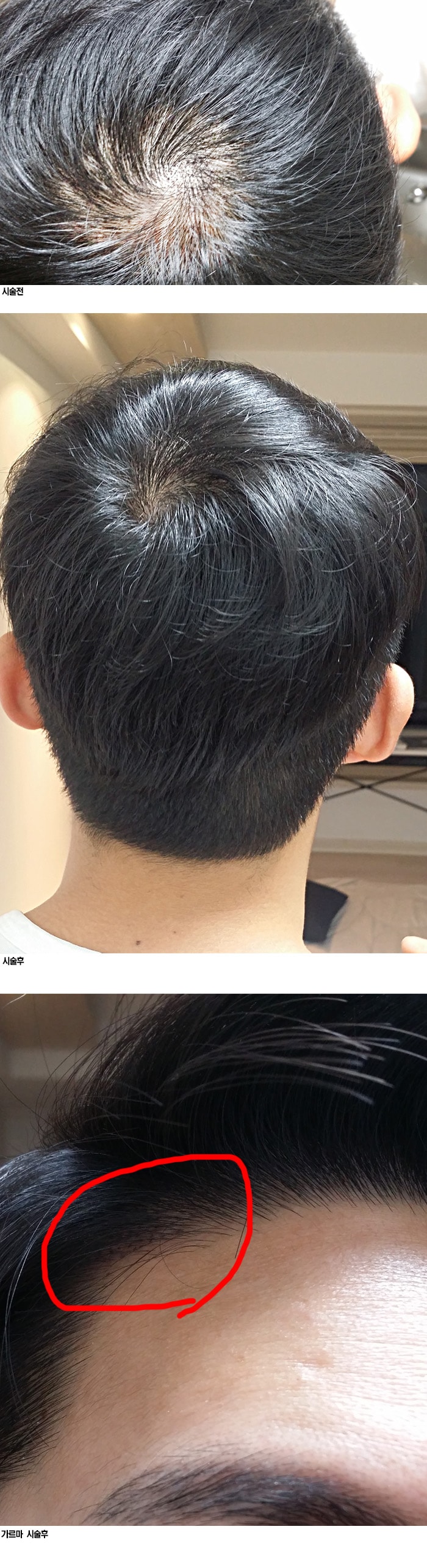 부산에서 큰맘 먹고 했씁니다  속찍한 후기!!