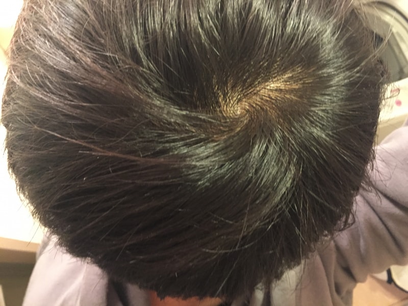 탈모약 3년 후기