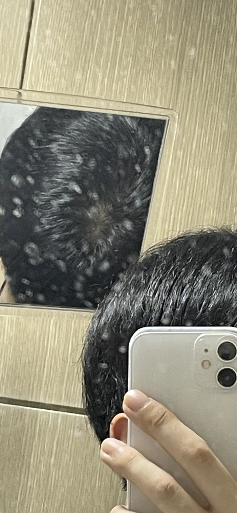 거울두개로 보면 그래도 양호탈모(?) ㅠㅠ