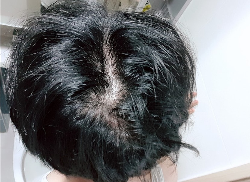 약먹기 시작했을때쯤 사진인듯 하네요