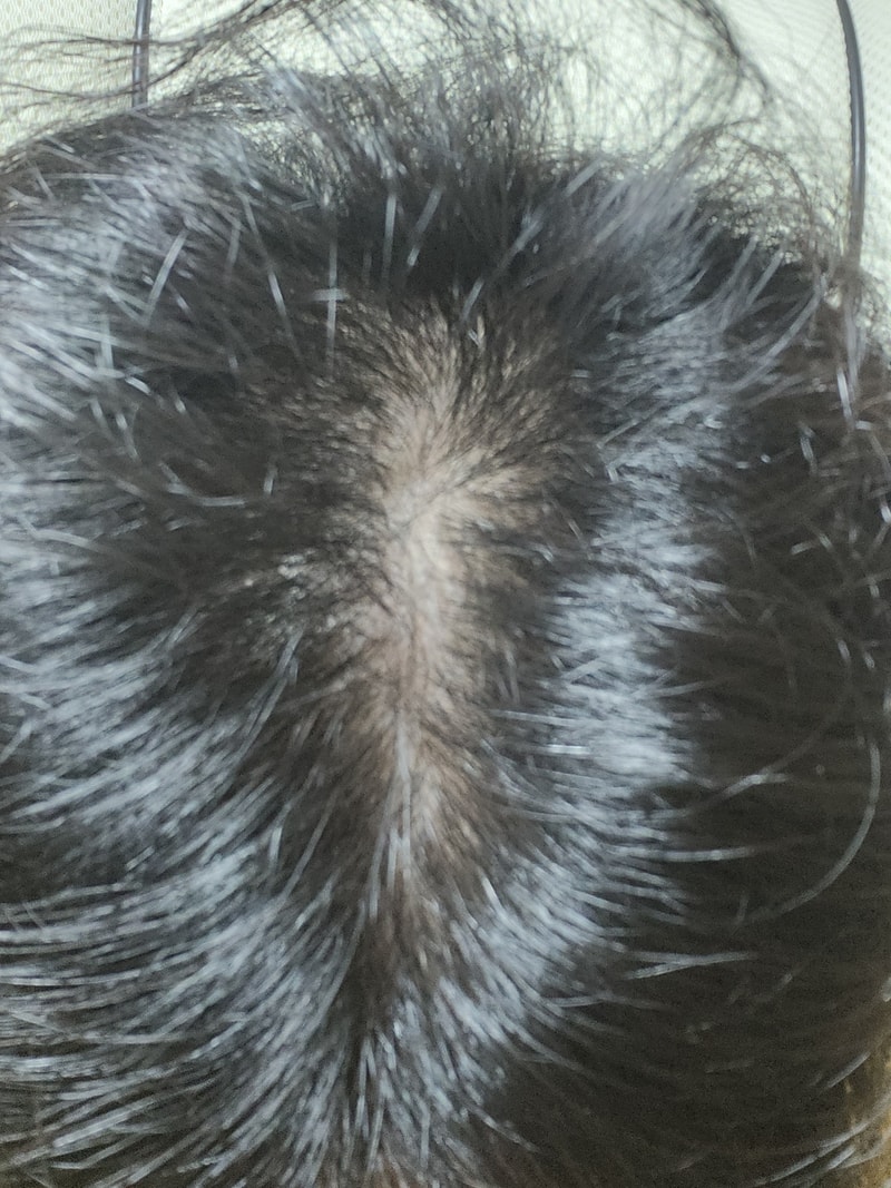 フィナステリッド4ヶ月の体験談です