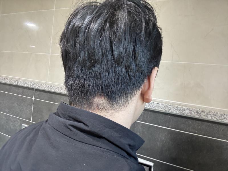 이거 원형탈모인가요?
