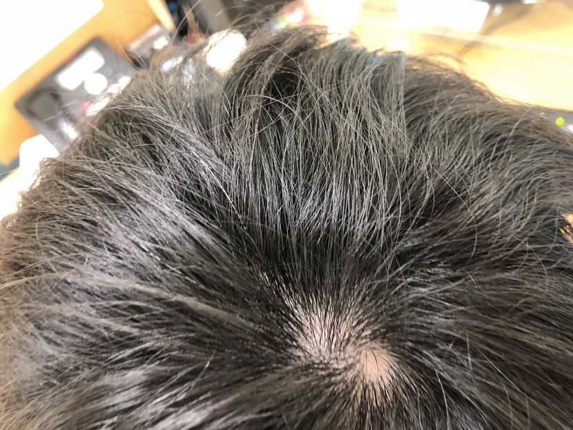 원형탈모(정수리)