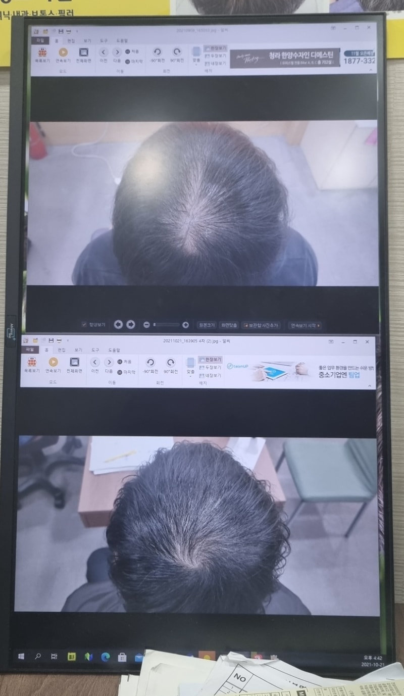 조합약복용+모낭주사 2개월차 후기 (feat. 두파형탈모인가?)