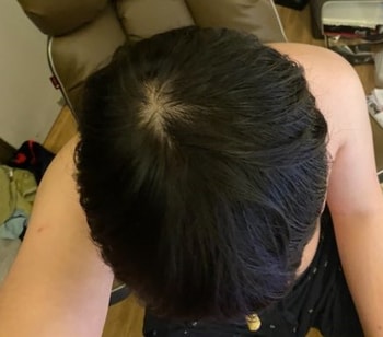 미녹시딜 바르기전 어두운 사진이라 더 숱이 있어보임 