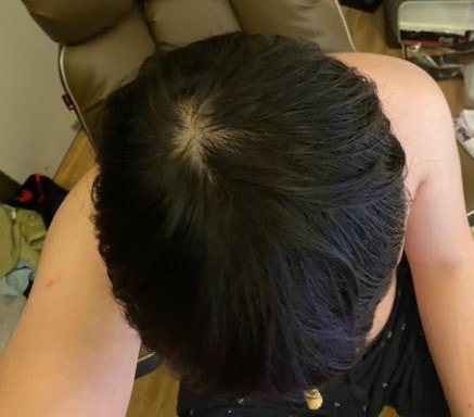 미녹시딜 바르기전 어두운 사진이라 더 숱이 있어보임 