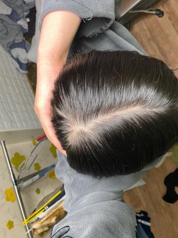 미녹시딜 한달 째 상태