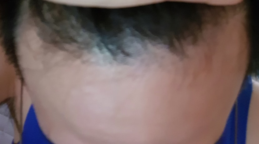 복합탈모