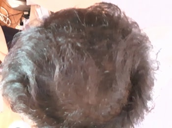 복합탈모
