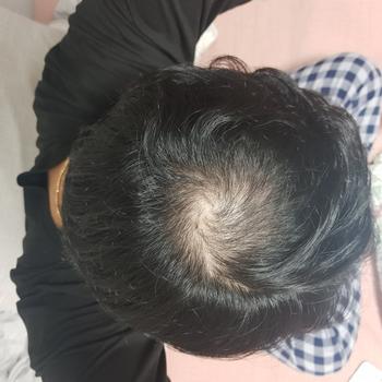 2022년 가장 정수리탈모가 심할때 사진