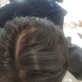 오늘 찍은 정수리 사진