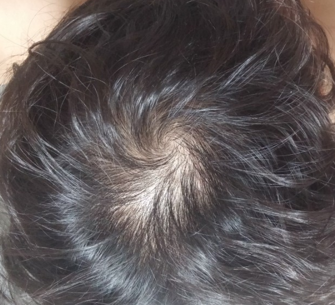 이건 7일후 머리안감고 찍은사진이구