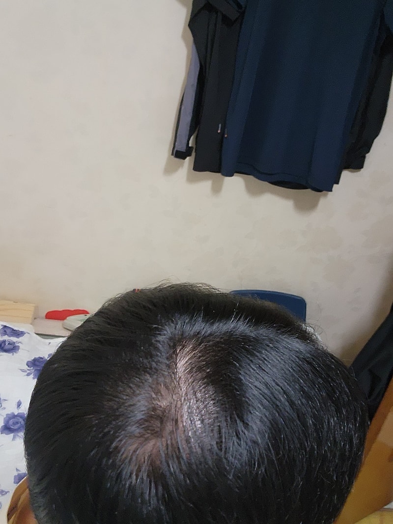 頭頂部の薄毛症、全体的な毛髪軟毛化状態ですね~