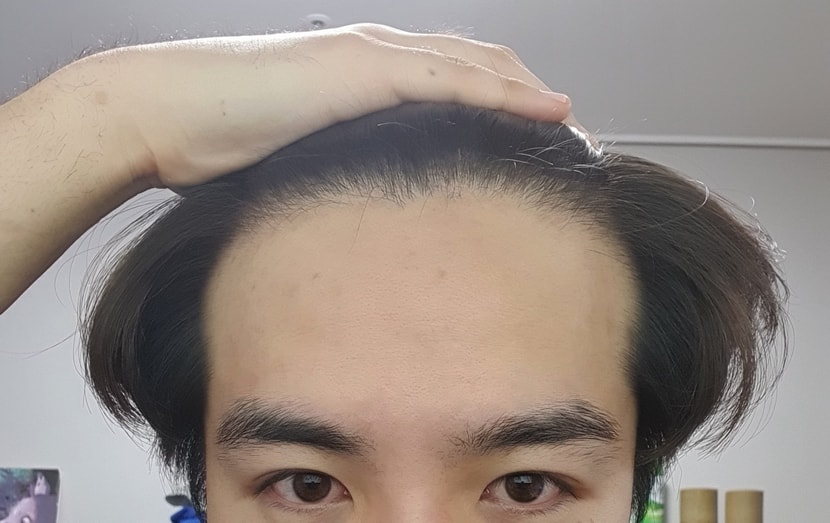 이마라인