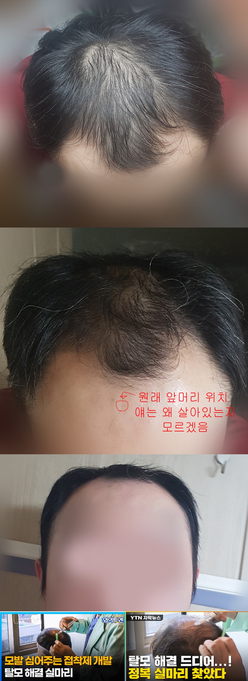 안녕하세요 33세 M자 탈모인입니다