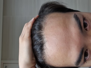 이마라인