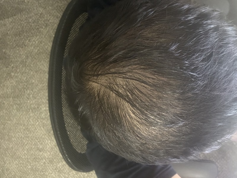 AGA治療薬を飲もうと思うんですが