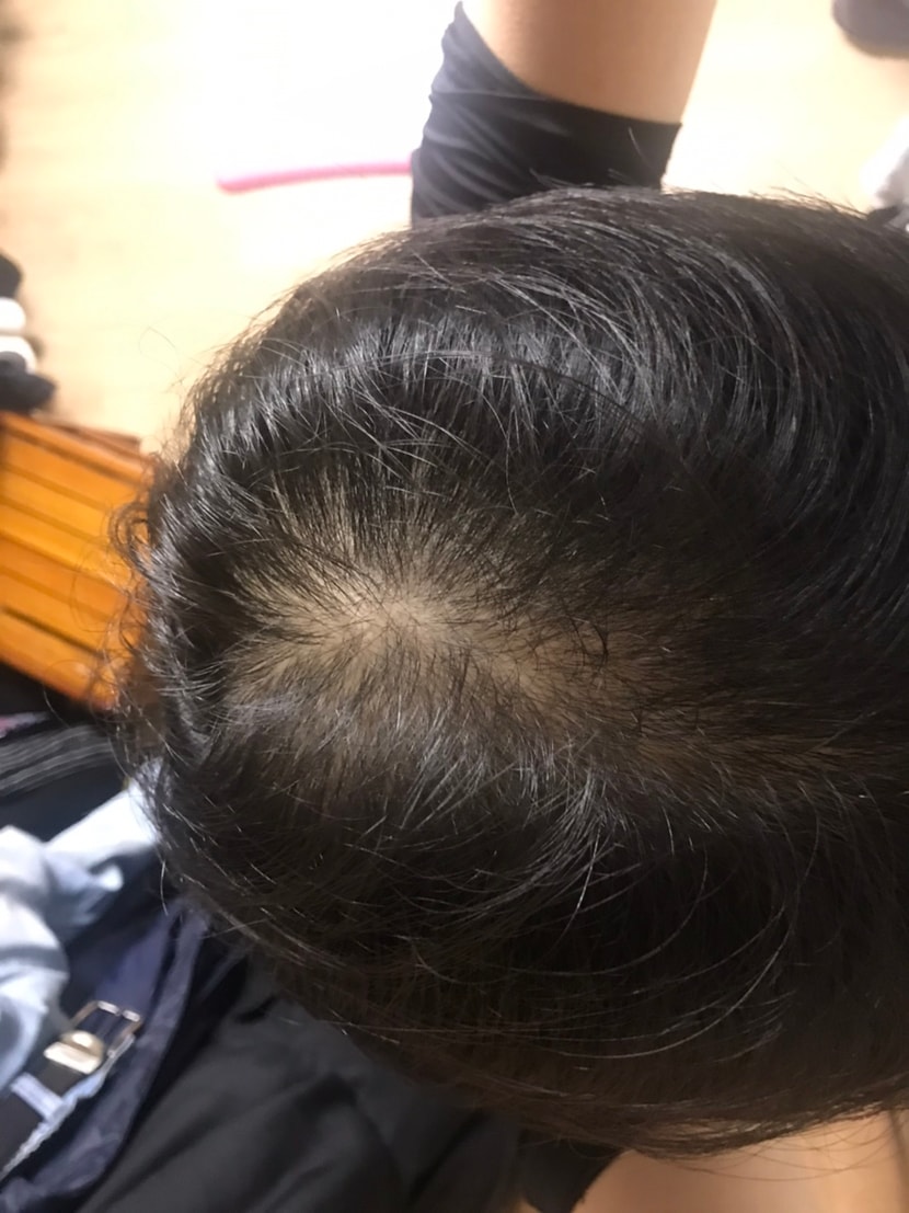 이건 오늘 손으로 머리 가르마지게 훑으면서 찍은 사진입니다. 아직 멀었네요 ㅠㅠ