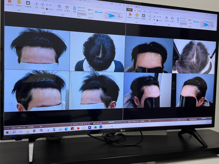 왼쪽이 탈모약 복용 전, 오른쪽이 먹은 후
