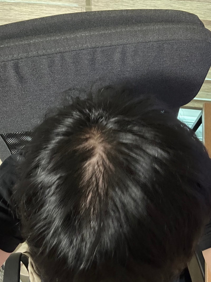이게 탈모인가요? ㅠㅠ