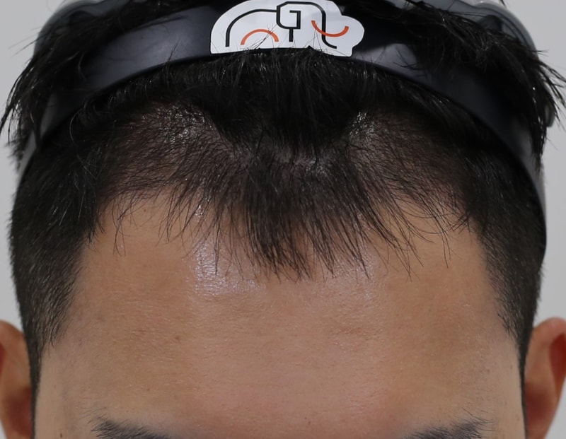 인천 모발이식 맘모스헤어라인 4개월 경과 후기