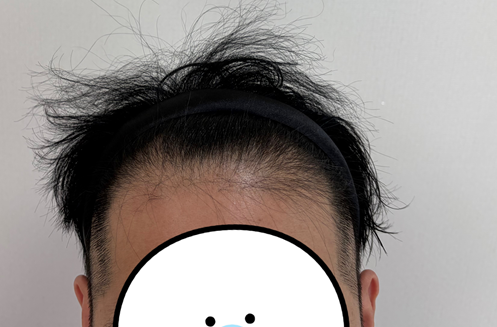 탈모약 먹는 중인데 주사나 이식 필요하겠죠?