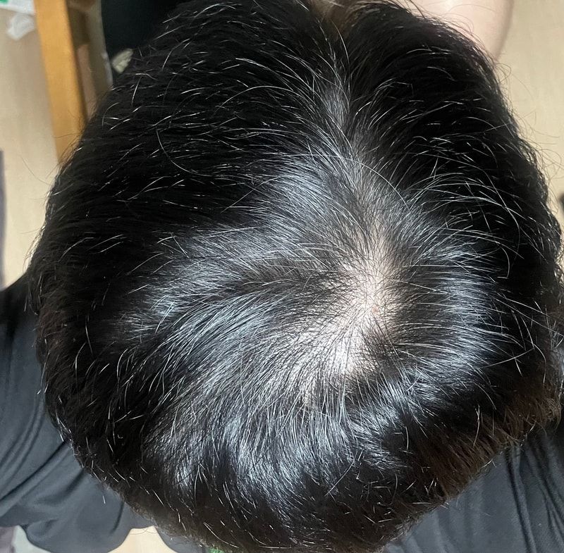 탈모수다