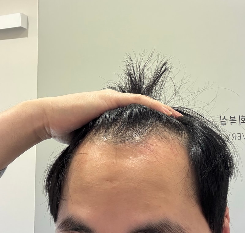 모발이식 받기 전 준비물 개인적으로 추천해줄 만한게 있나요?