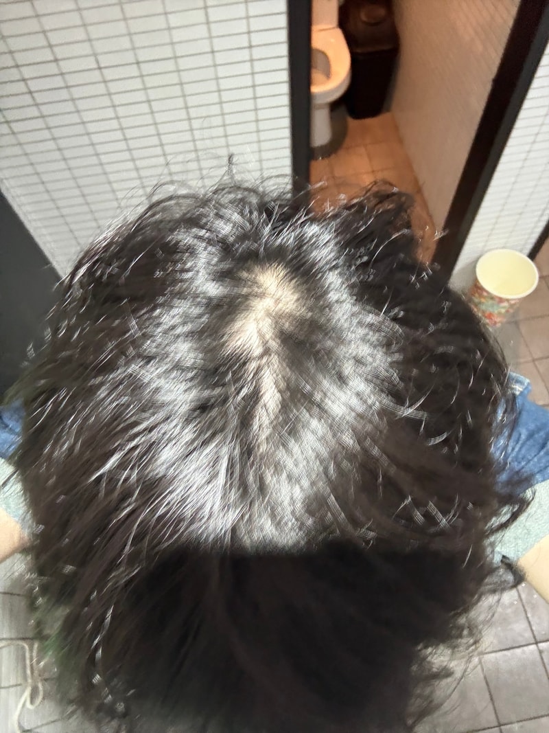 탈모수다
