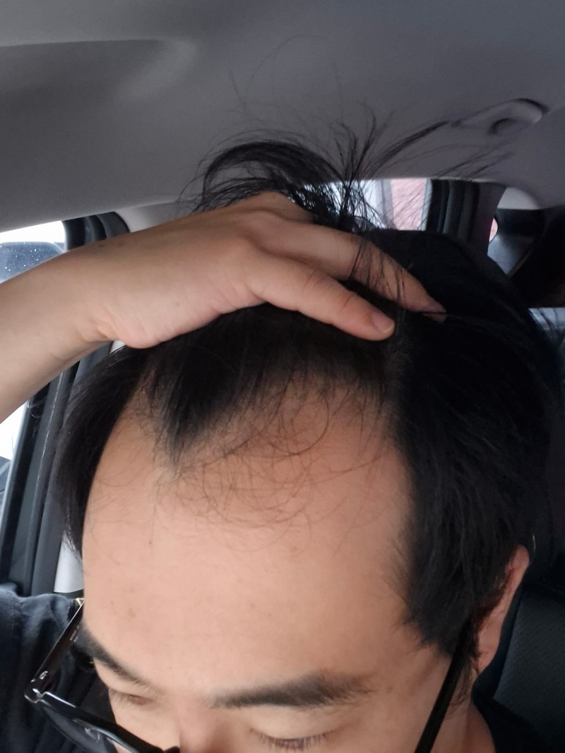 脱发对话