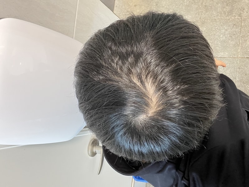 23 남자 갑자기 탈모가 올 수도 있는건가요?