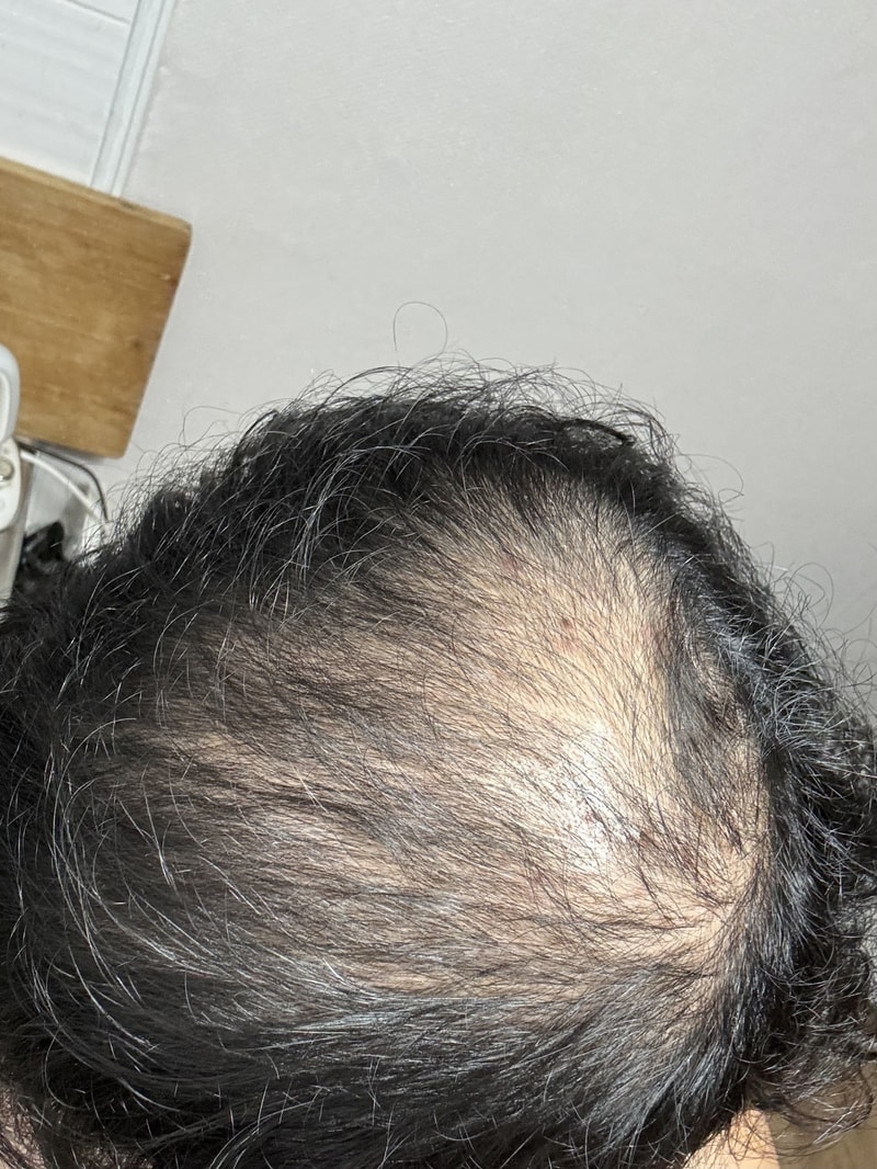 레전드 정수리 탈모인..