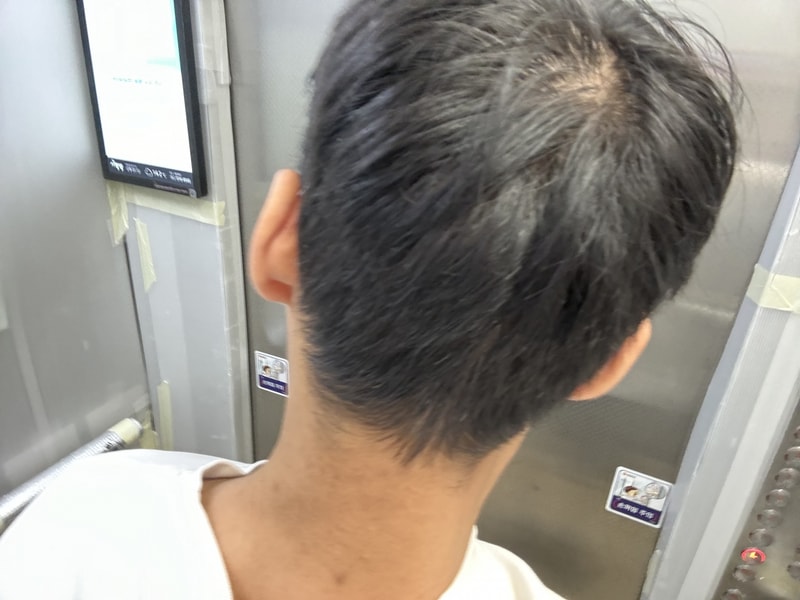 私より頭頂部薄毛がひどい人いますか？？？