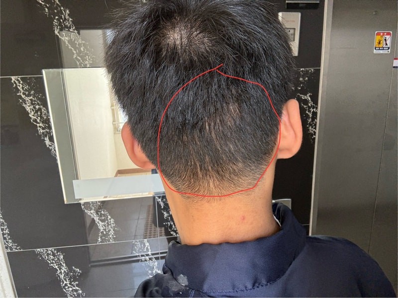 植毛後、後ろ髪の状態(泣)