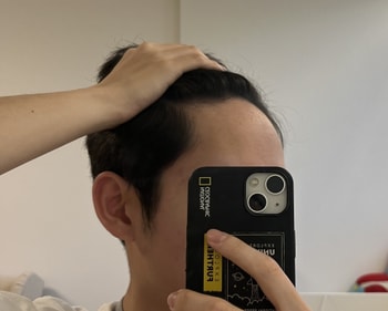 약 복용 중 오늘(피나 3개월 반 복용)