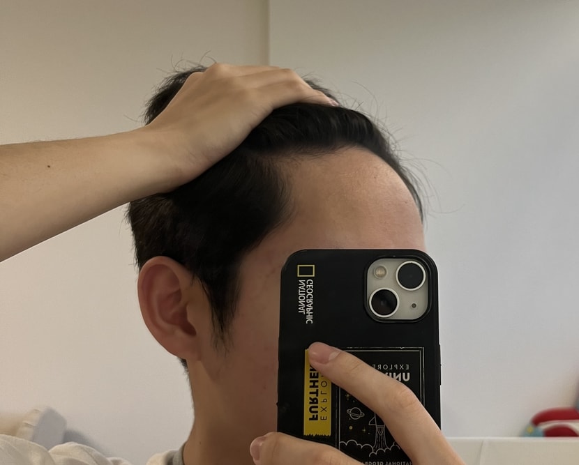 약 복용 중 오늘(피나 3개월 반 복용)