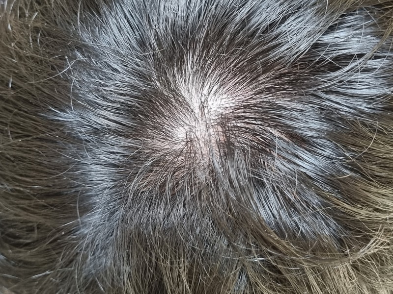 Finastra已经过了8个月了，头发一直在掉。