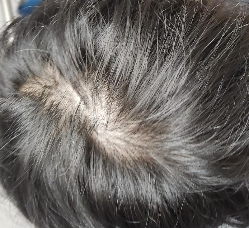 먹는 미녹시딜정 관련.. 질문