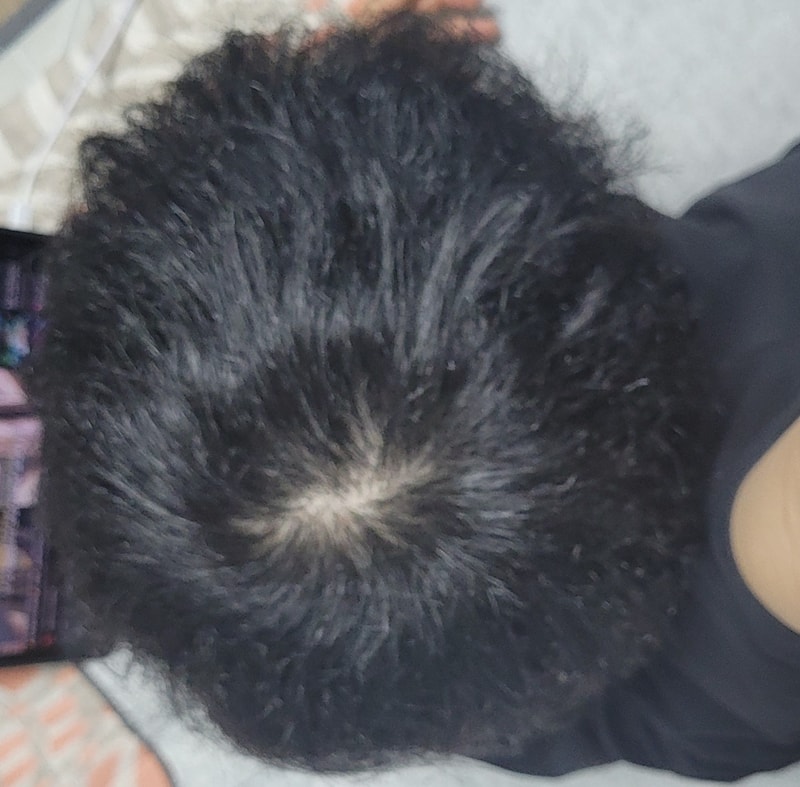 ピナ服用4ヶ月目、未緑錠服用3ヶ月目