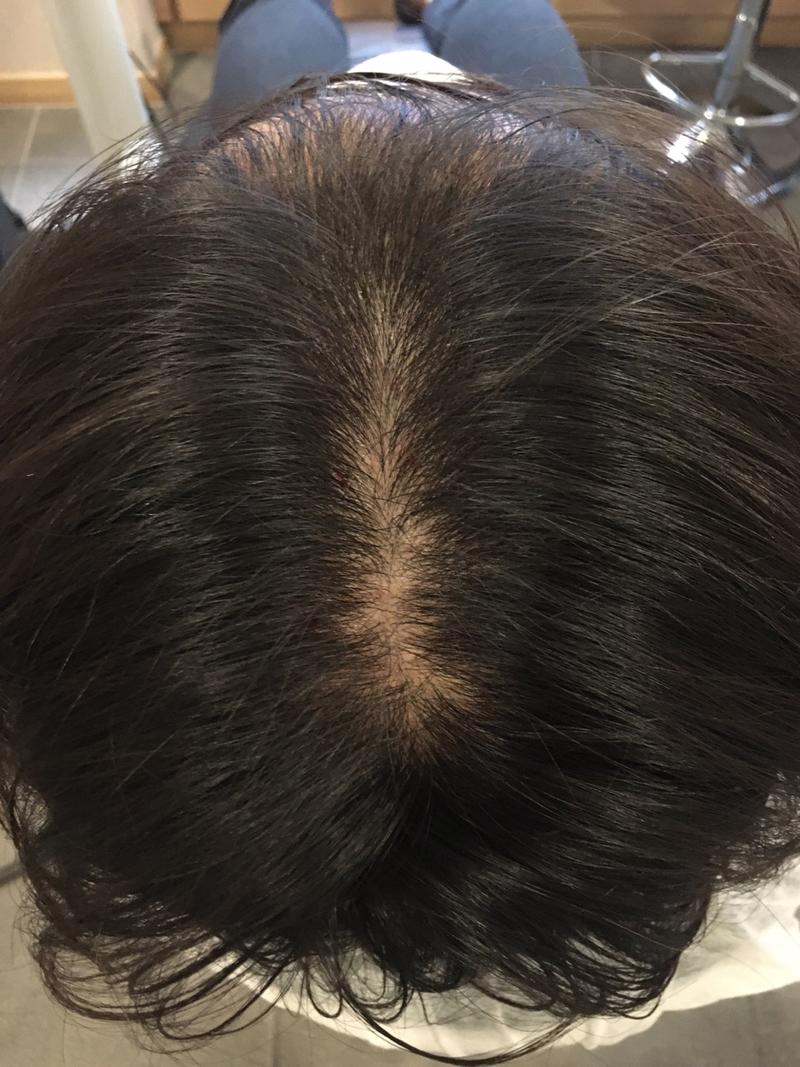 탈모 모낭주사 효과있을까요?? PRP 엑소좀 리제네라등.. 서론이 좀 길어요ㅜㅜ