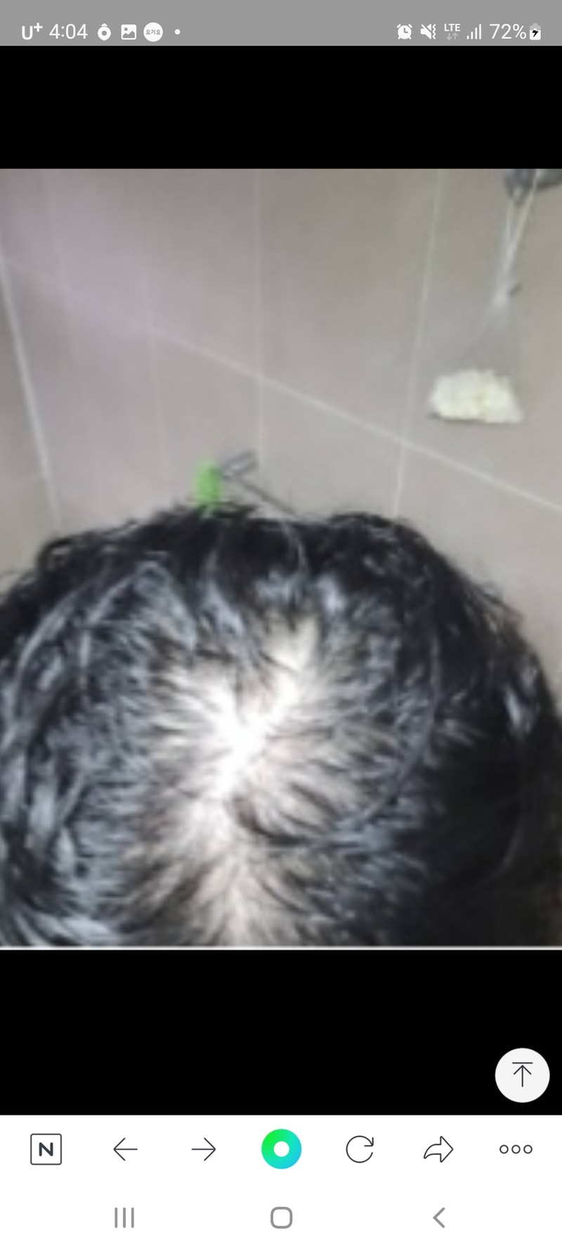 頭皮薄毛症 薬服用2ヶ月目、濡れた髪の状態