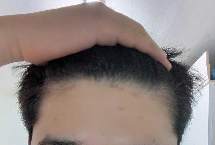 약 복용 1년 2개월 현재 정면