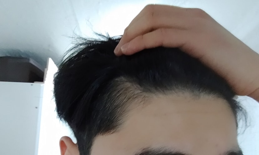 약 복용 전 우측