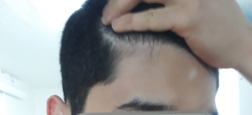 약 복용 5개월 후 좌측