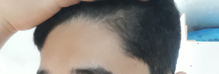 약 복용 5개월 후 우측