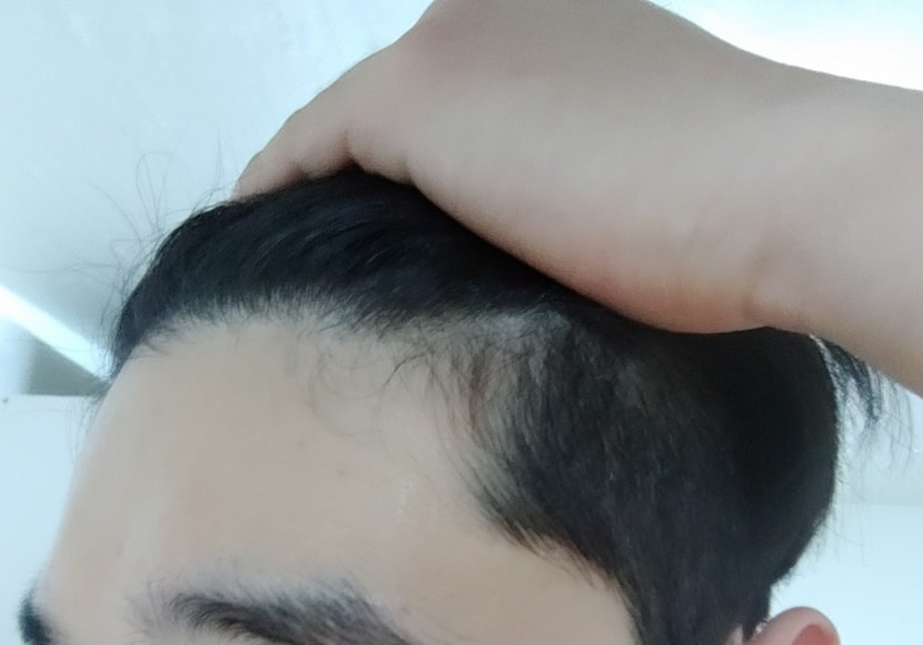약 복용 전 좌측